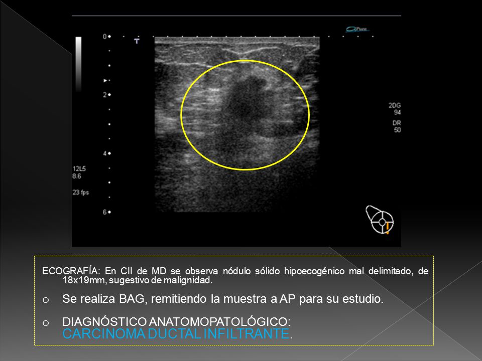 Se realiza BAG, remitiendo la muestra a AP para su estudio.