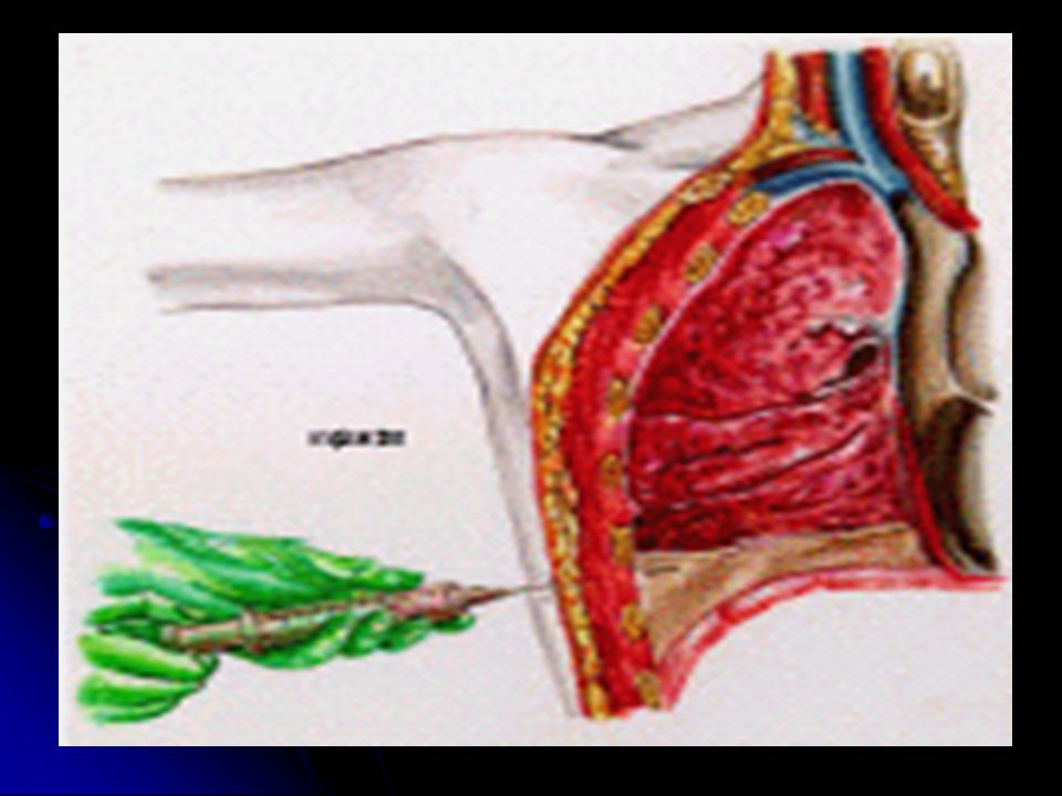 La realización de la toracocentesis es la piedra angular del diagnostico etiológico