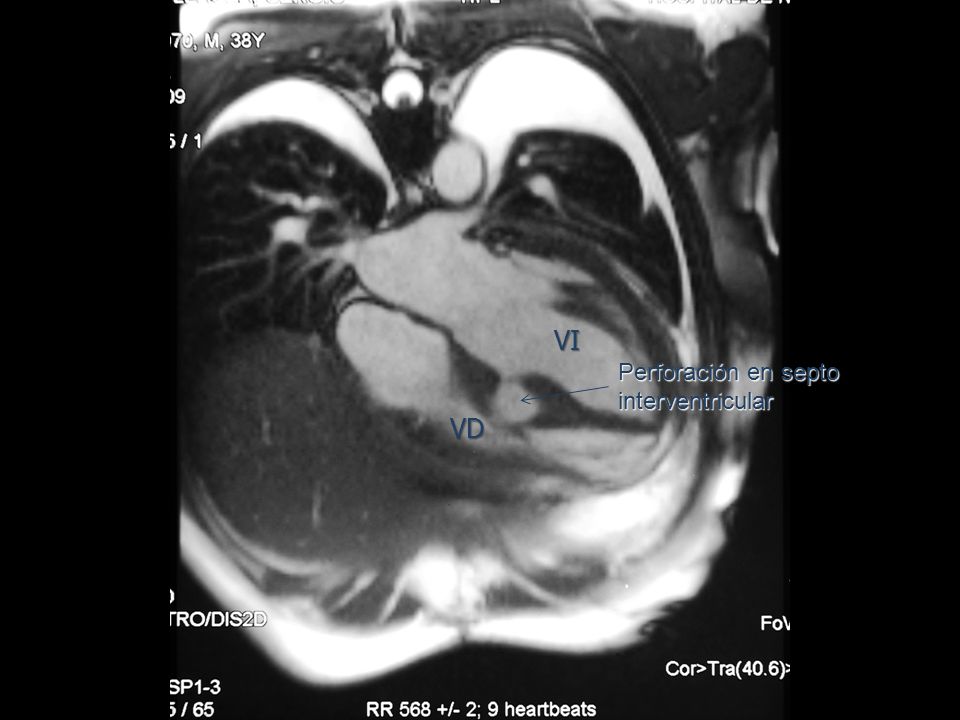 VI Perforación en septo interventricular VD