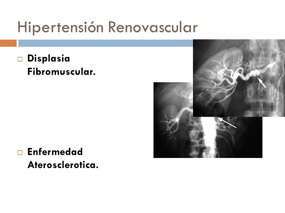 Hipertensión Renovascular
