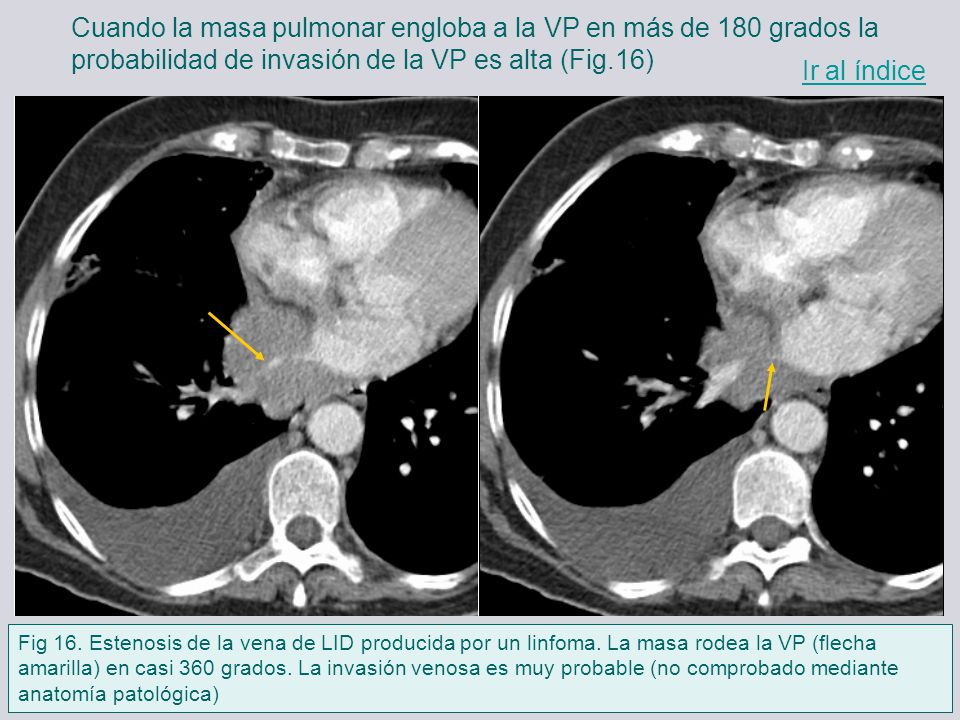 Cuando la masa pulmonar engloba a la VP en más de 180 grados la