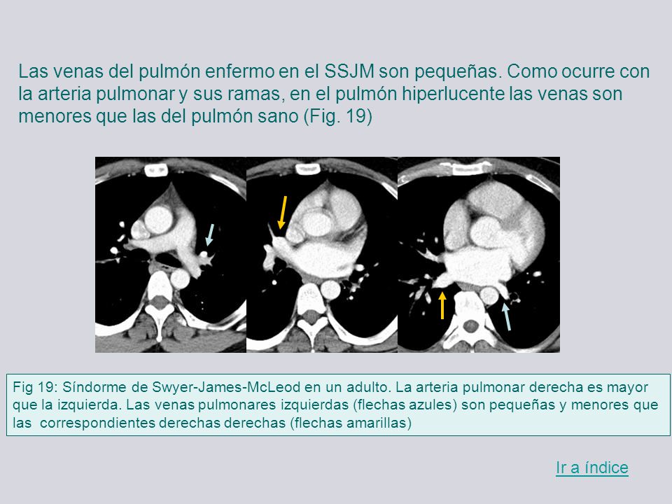 Las venas del pulmón enfermo en el SSJM son pequeñas. Como ocurre con
