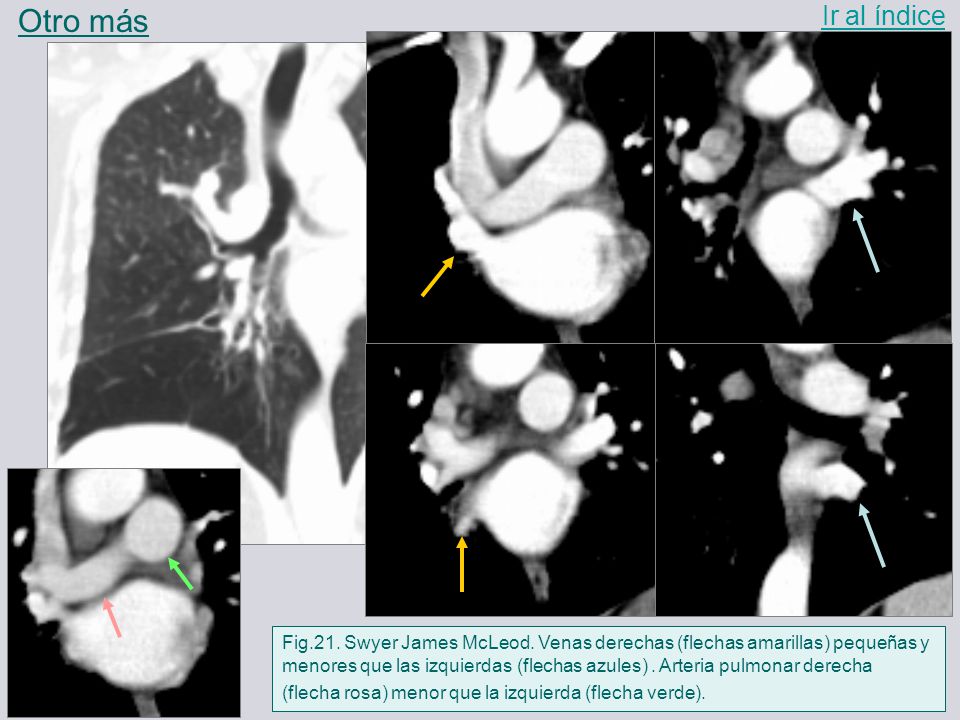 Otro más Ir al índice. Fig.21. Swyer James McLeod. Venas derechas (flechas amarillas) pequeñas y.