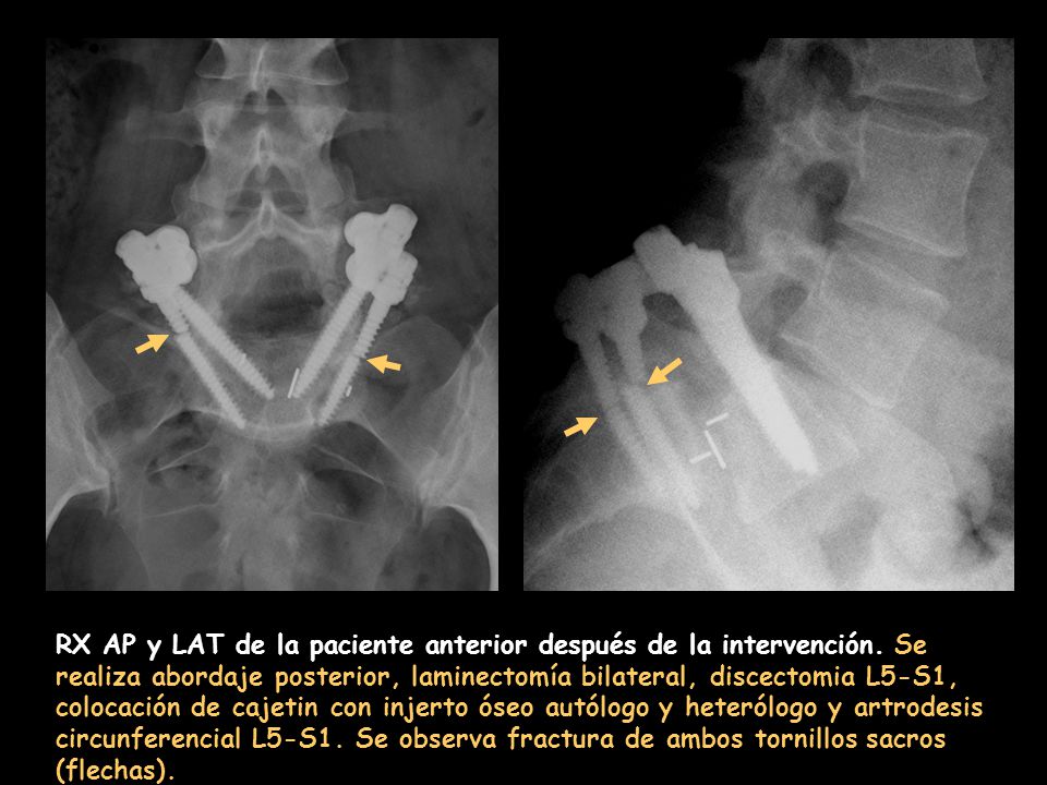 RX AP y LAT de la paciente anterior después de la intervención