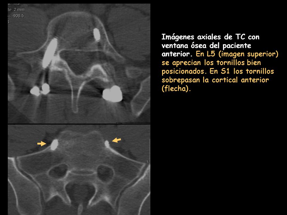 Imágenes axiales de TC con ventana ósea del paciente anterior