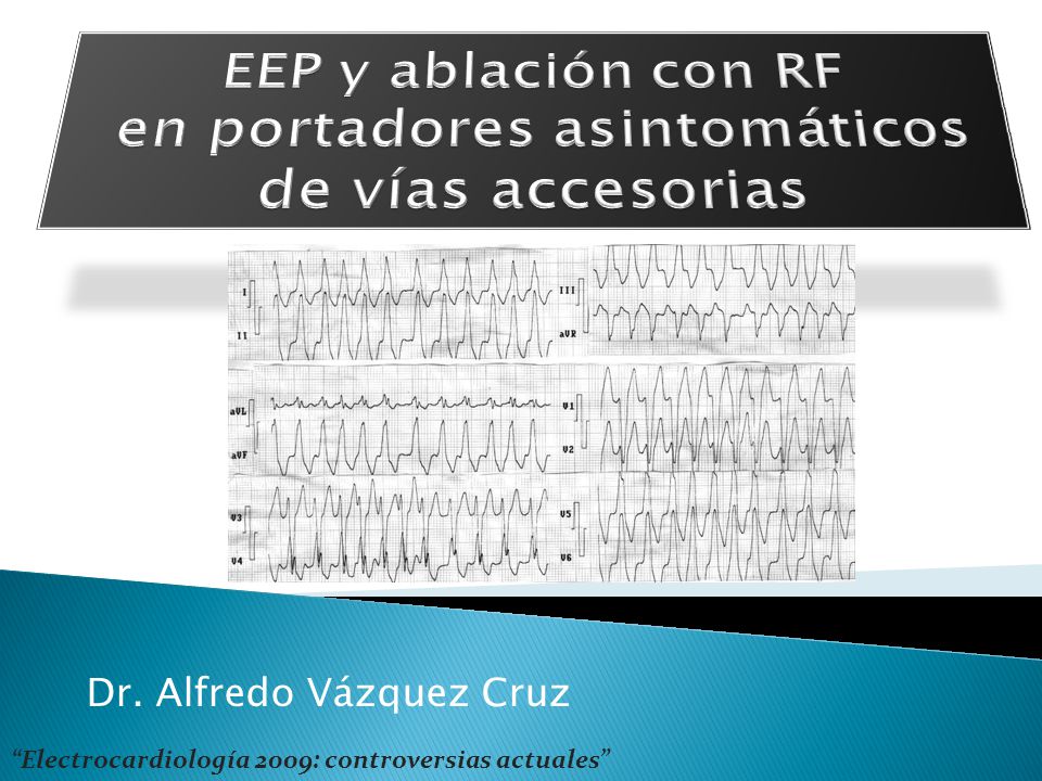 EEP y ablación con RF en portadores asintomáticos de vías accesorias