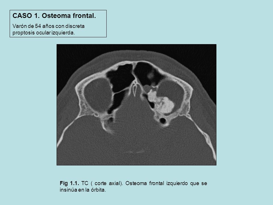 CASO 1. Osteoma frontal. Varón de 54 años con discreta proptosis ocular izquierda.