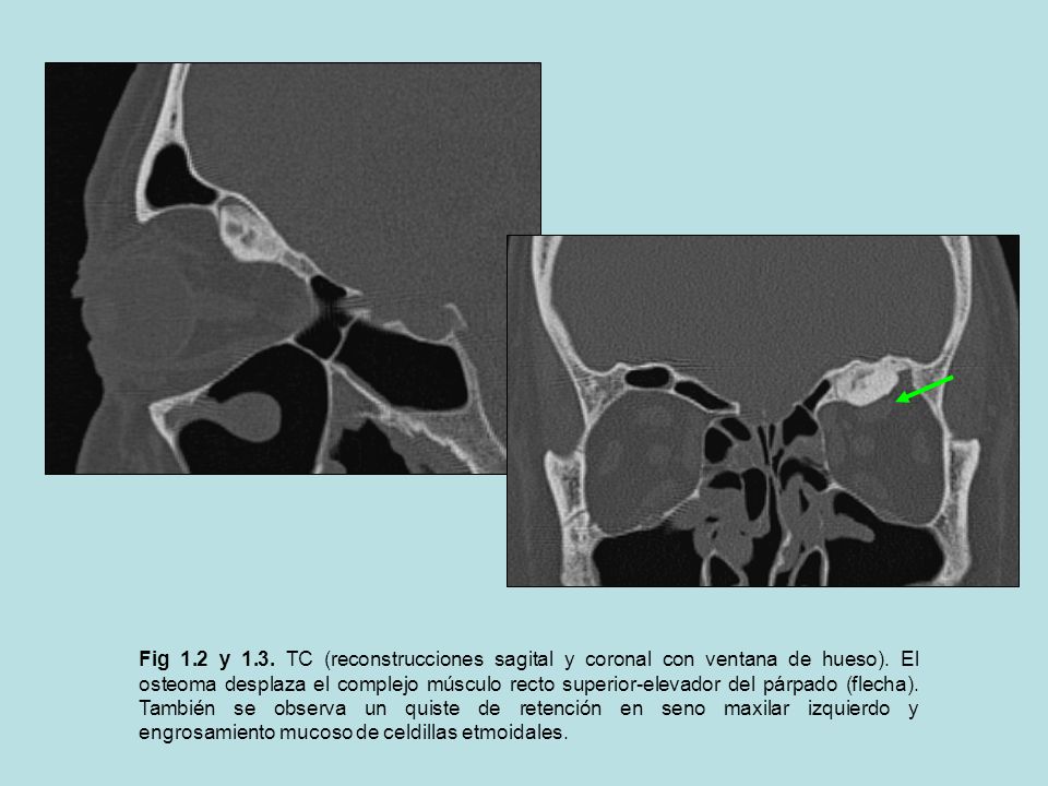 Fig 1.2 y 1.3. TC (reconstrucciones sagital y coronal con ventana de hueso).