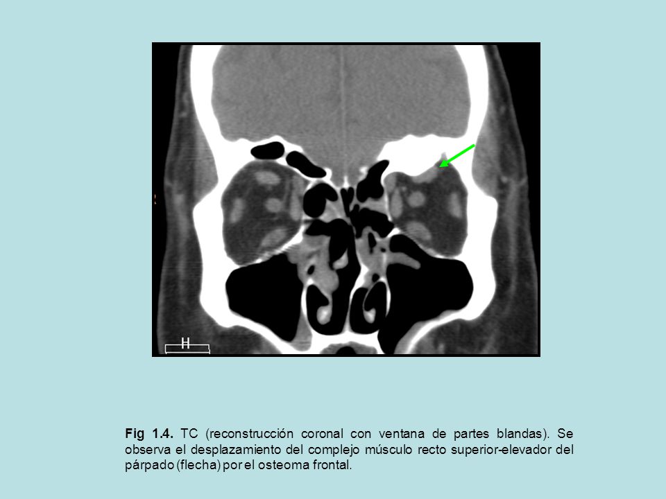 Fig TC (reconstrucción coronal con ventana de partes blandas)