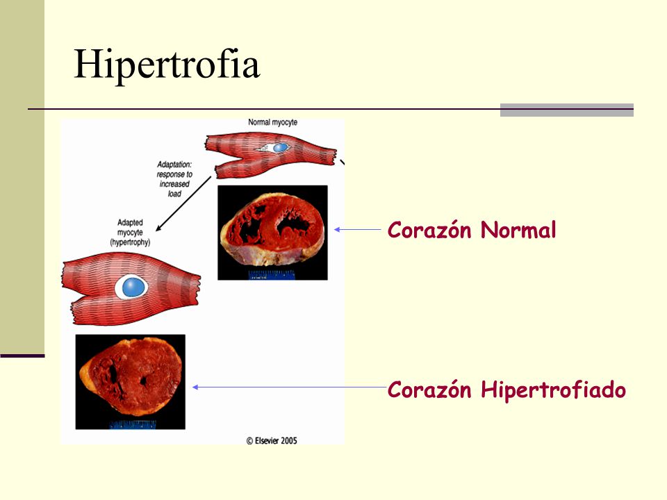 Hipertrofia Corazón Normal Corazón Hipertrofiado