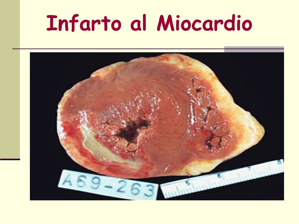 Infarto al Miocardio A pale, whitish infarct is surrounded by a zone of hyperemia (vascular dilatation)