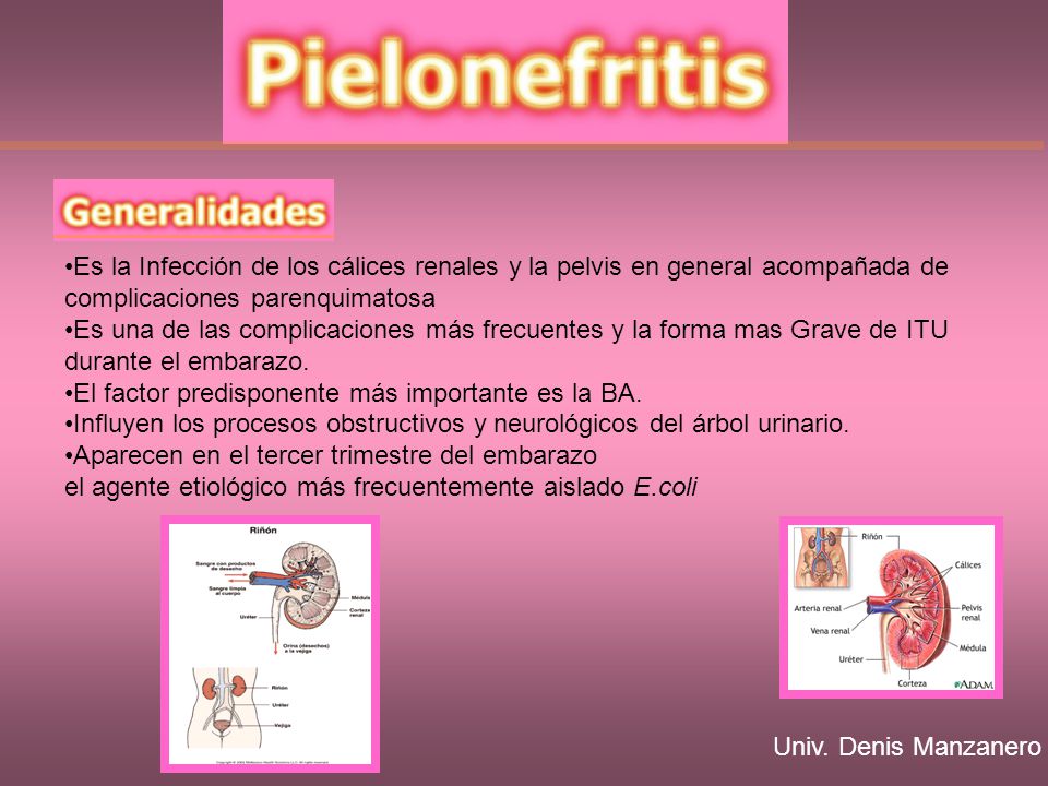 Es la Infección de los cálices renales y la pelvis en general acompañada de complicaciones parenquimatosa