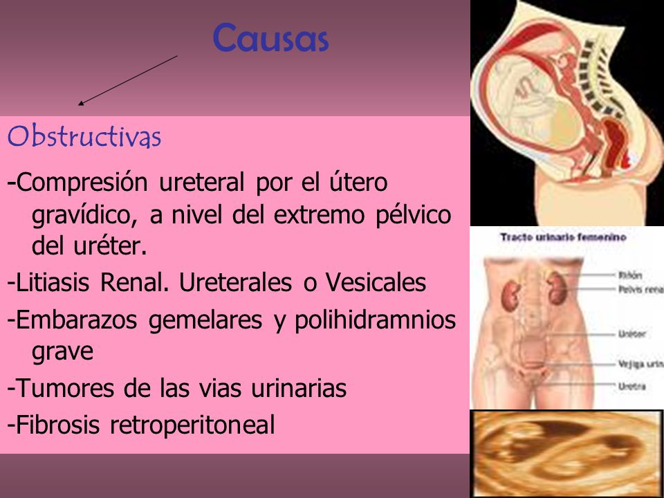 Causas Obstructivas. -Compresión ureteral por el útero gravídico, a nivel del extremo pélvico del uréter.