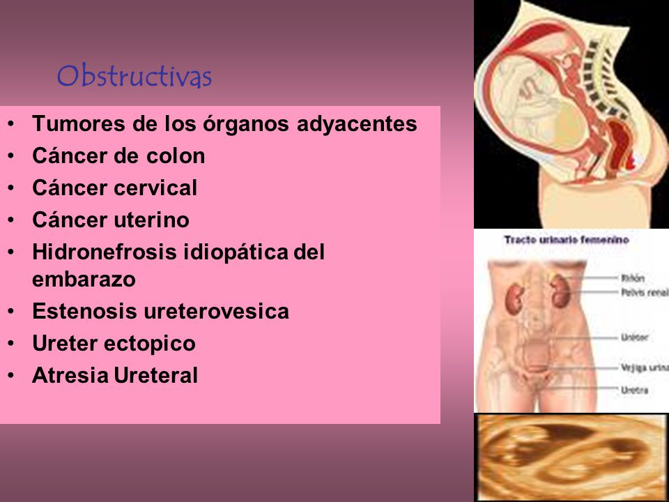 Obstructivas Tumores de los órganos adyacentes Cáncer de colon