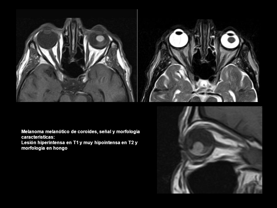 Melanoma melanótico de coroides, señal y morfología