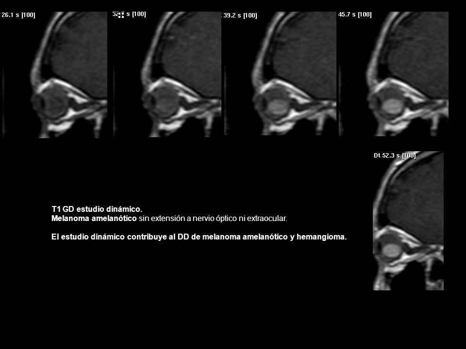 T1 GD estudio dinámico. Melanoma amelanótico sin extensión a nervio óptico ni extraocular.