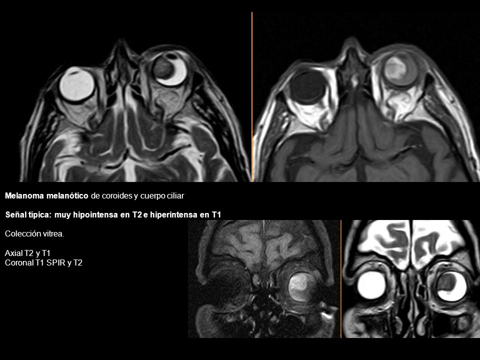 Melanoma melanótico de coroides y cuerpo ciliar