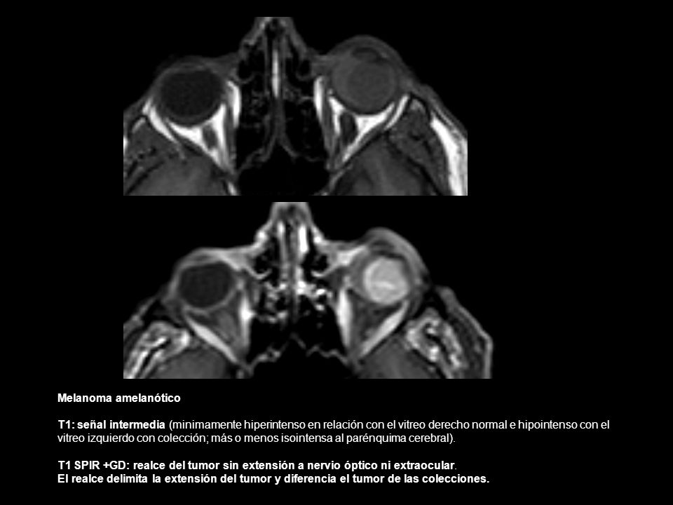 Melanoma amelanótico T1: señal intermedia (minimamente hiperintenso en relación con el vitreo derecho normal e hipointenso con el.