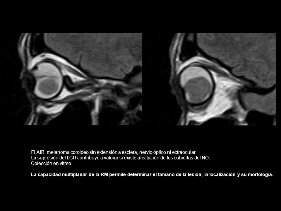 FLAIR: melanoma coroideo sin extensión a esclera, nervio óptico ni extraocular.