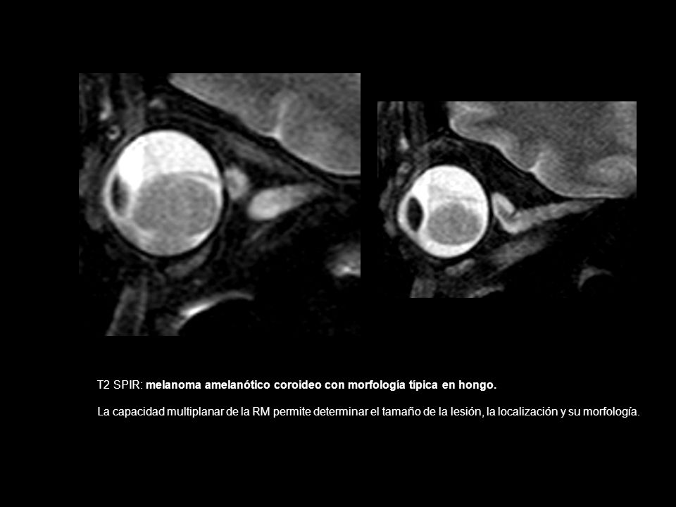 T2 SPIR: melanoma amelanótico coroideo con morfología típica en hongo.