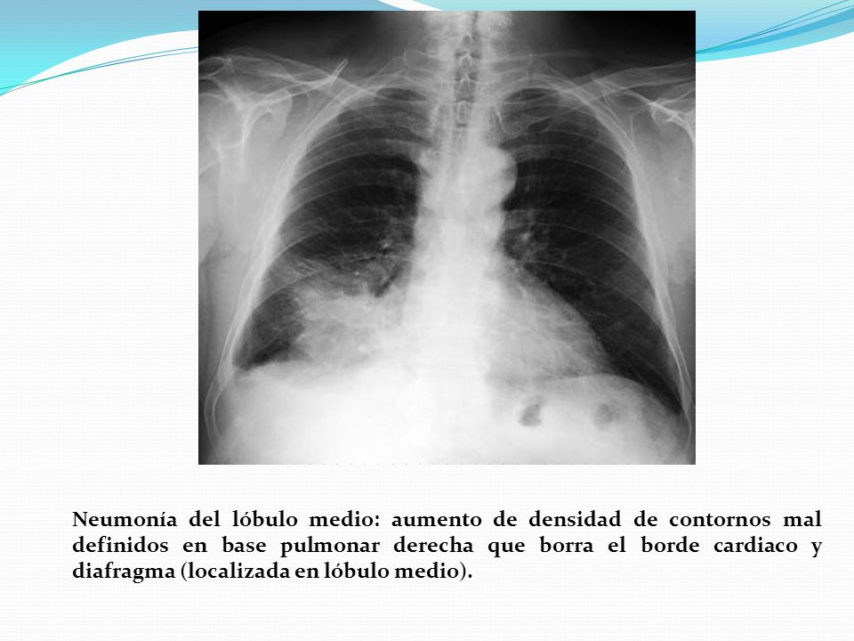 Neumonía del lóbulo medio: aumento de densidad de contornos mal definidos en base pulmonar derecha que borra el borde cardiaco y diafragma (localizada en lóbulo medio).