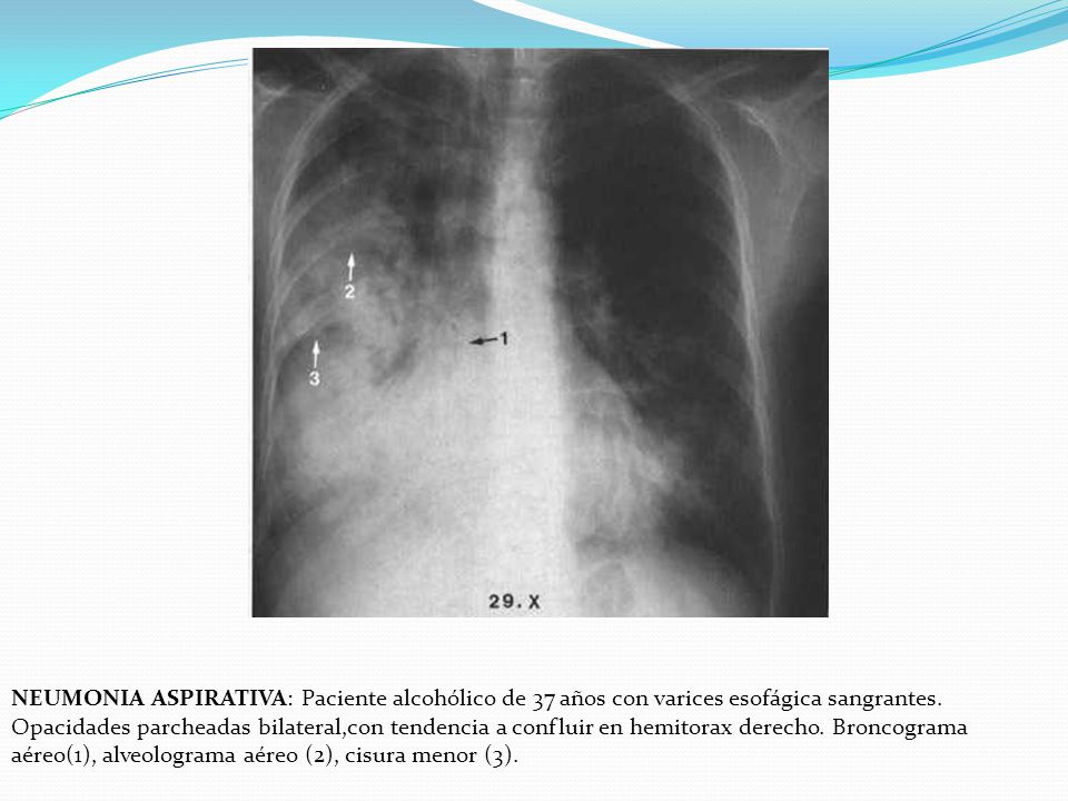 NEUMONIA ASPIRATIVA: Paciente alcohólico de 37 años con varices esofágica sangrantes.