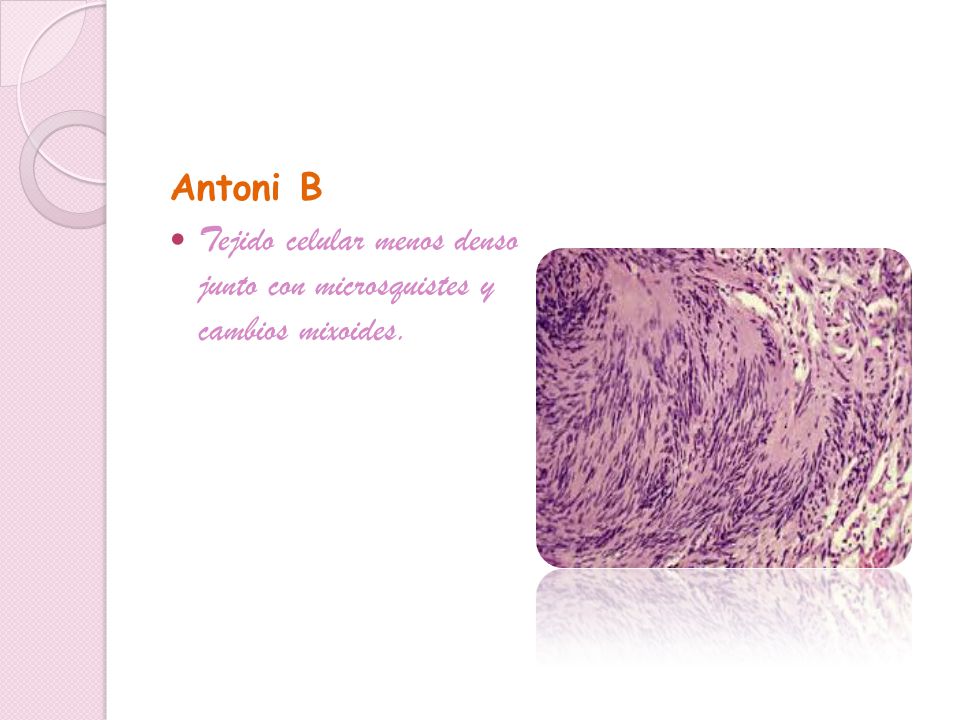 Antoni B Tejido celular menos denso junto con microsquistes y cambios mixoides.