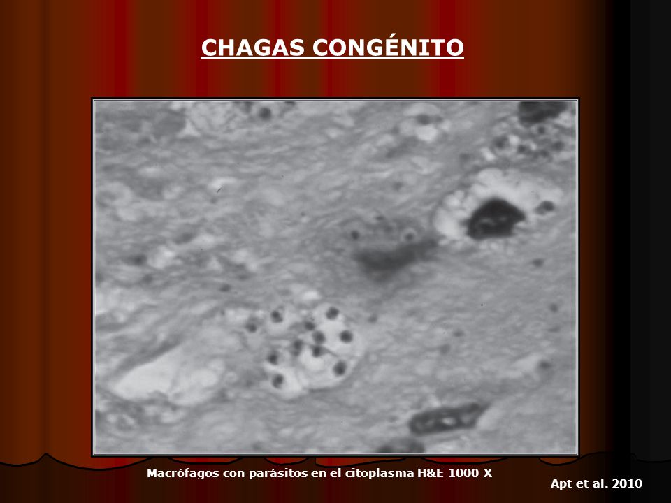 CHAGAS CONGÉNITO Macrófagos con parásitos en el citoplasma H&E 1000 X