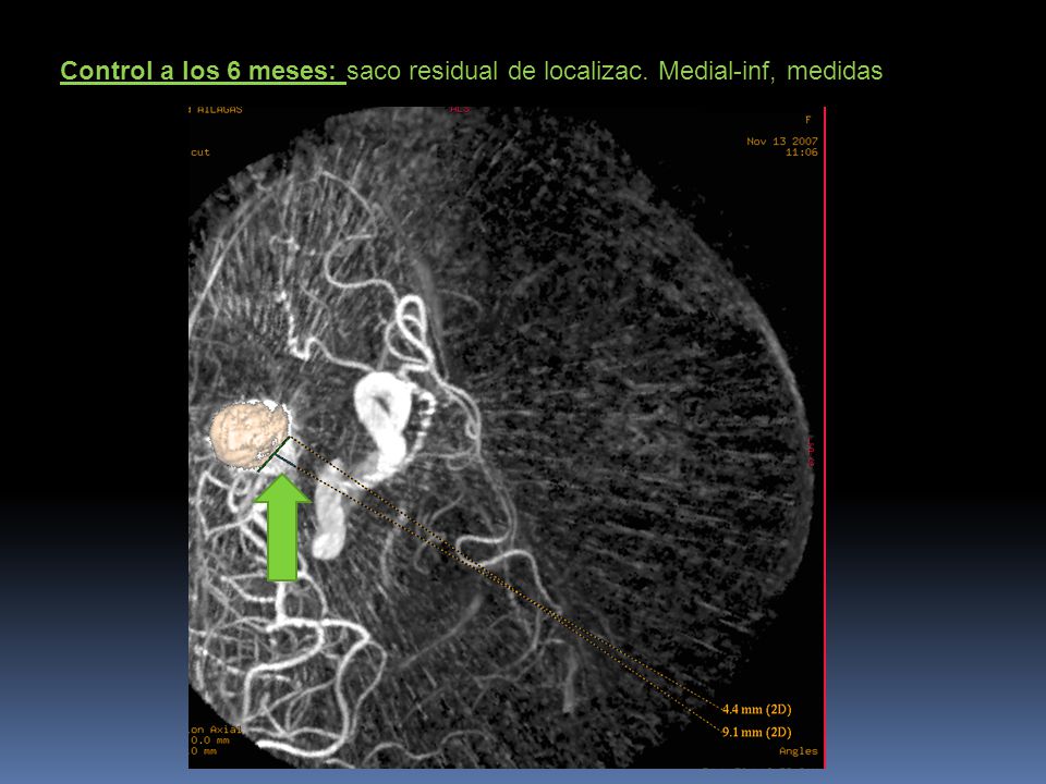 Control a los 6 meses: saco residual de localizac. Medial-inf, medidas