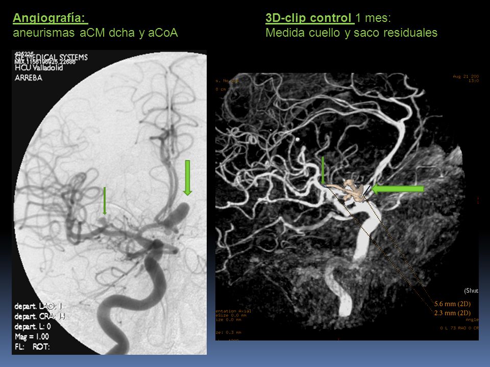 Angiografía: aneurismas aCM dcha y aCoA 3D-clip control 1 mes: Medida cuello y saco residuales