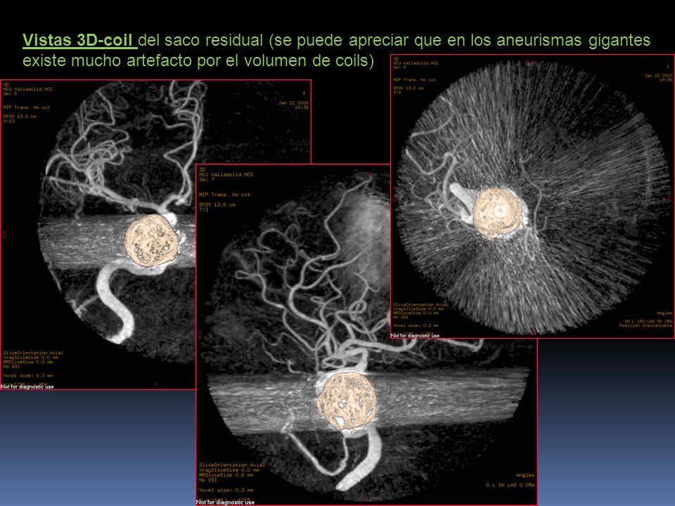 Vistas 3D-coil del saco residual (se puede apreciar que en los aneurismas gigantes