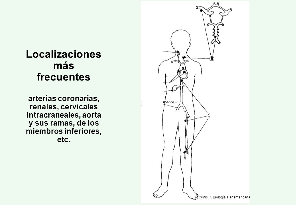 Localizaciones más frecuentes arterias coronarias, renales, cervicales intracraneales, aorta y sus ramas, de los miembros inferiores, etc.
