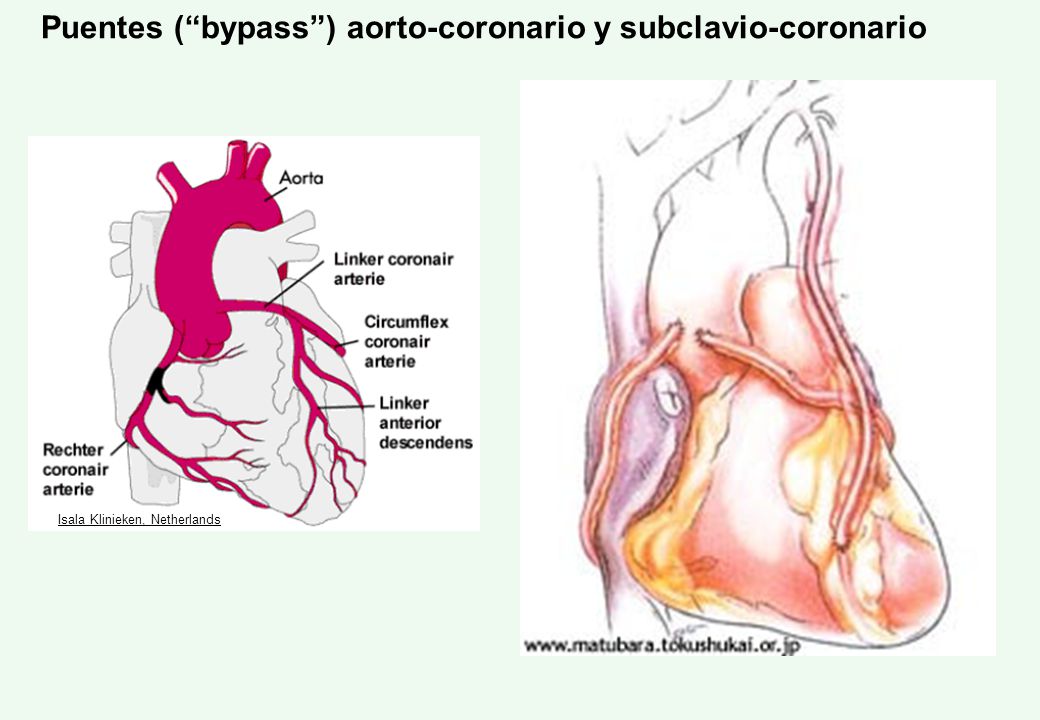 Puentes ( bypass ) aorto-coronario y subclavio-coronario