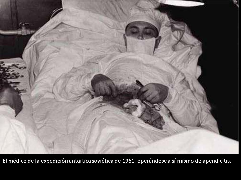 El médico de la expedición antártica soviética de 1961, operándose a sí mismo de apendicitis.