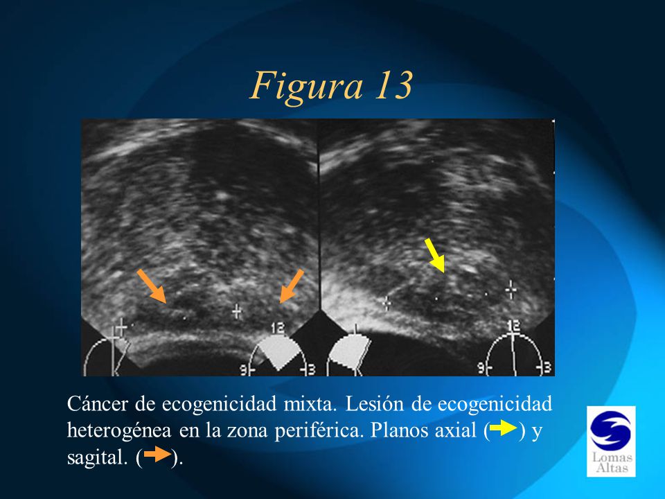 Figura 13 Cáncer de ecogenicidad mixta. Lesión de ecogenicidad heterogénea en la zona periférica.