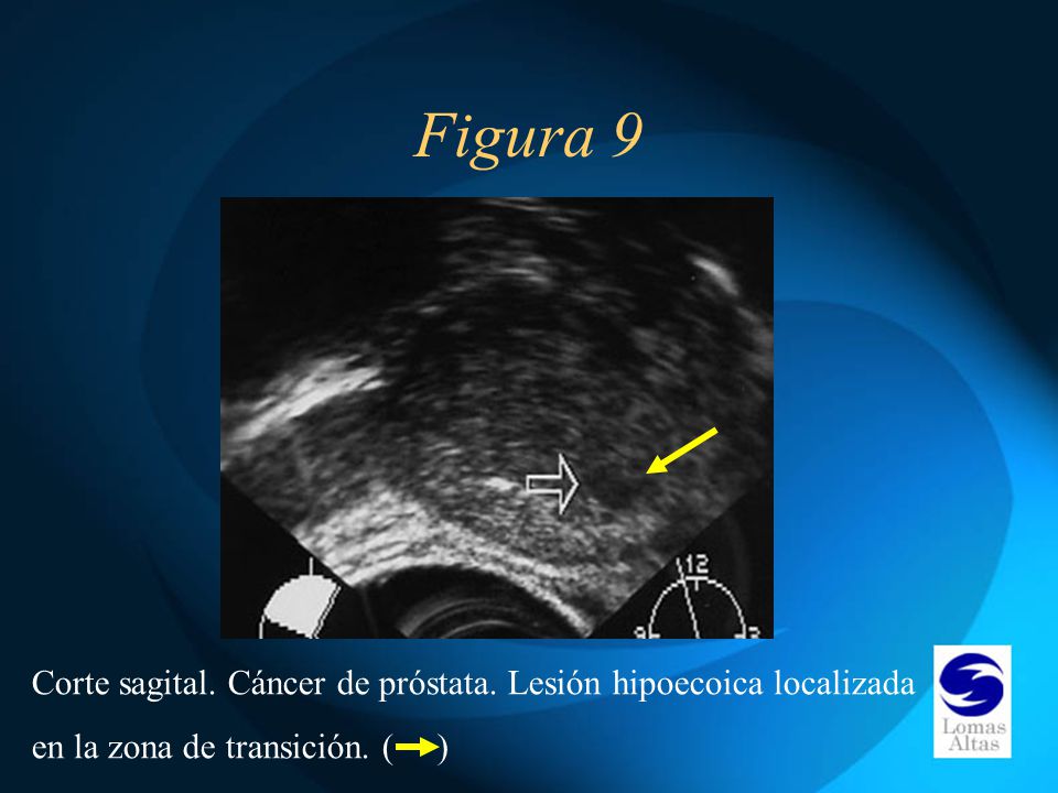Figura 9 Corte sagital. Cáncer de próstata. Lesión hipoecoica localizada.