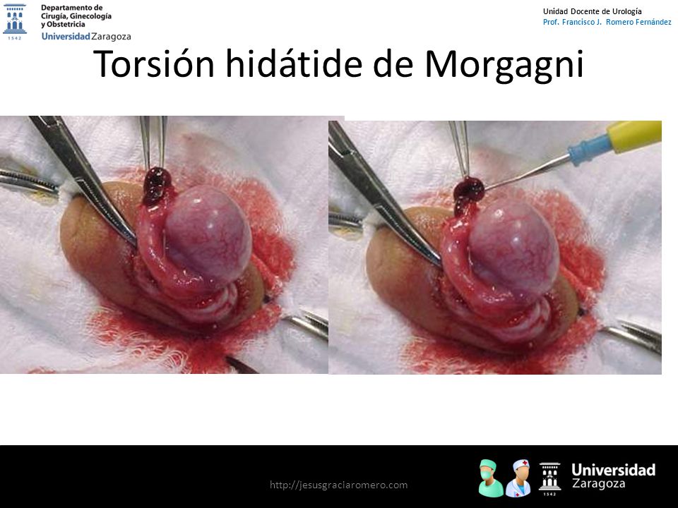 Torsión hidátide de Morgagni