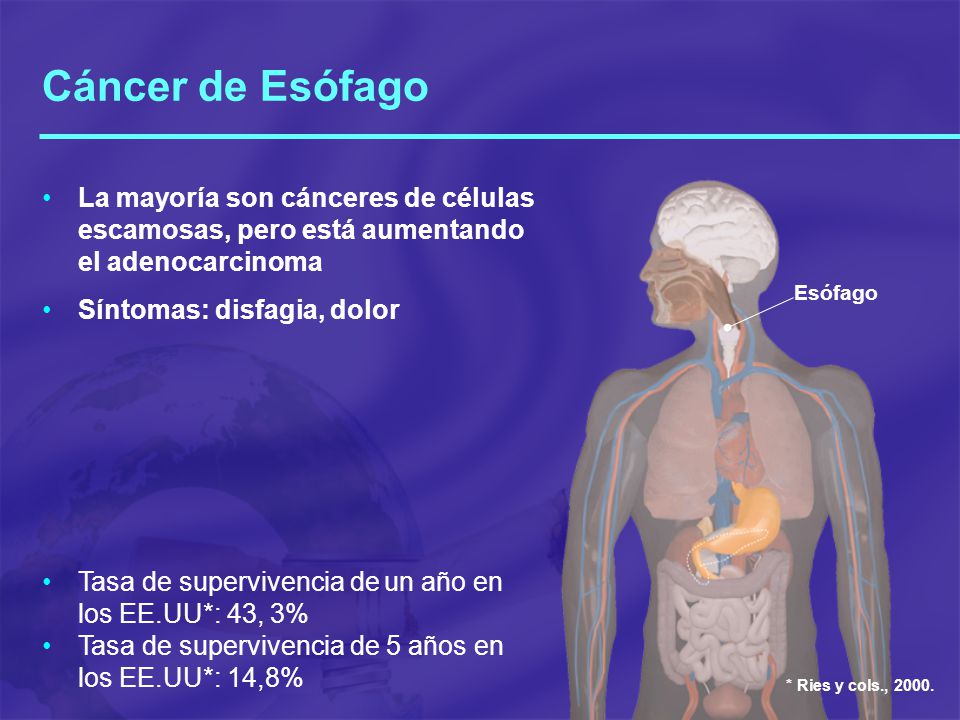 Cáncer de Esófago La mayoría son cánceres de células escamosas, pero está aumentando el adenocarcinoma.