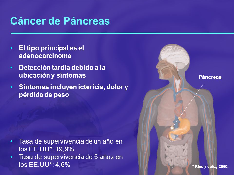 Cáncer de Páncreas El tipo principal es el adenocarcinoma