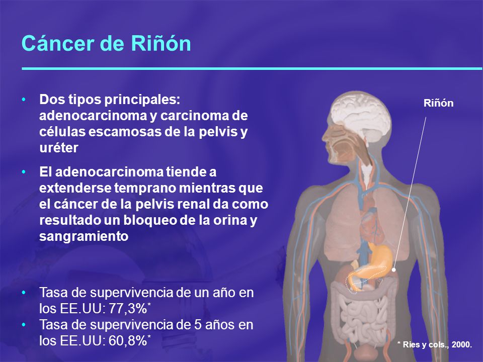 Cáncer de Riñón Dos tipos principales: adenocarcinoma y carcinoma de células escamosas de la pelvis y uréter.