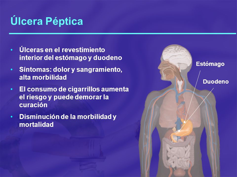 Úlcera Péptica Úlceras en el revestimiento interior del estómago y duodeno. Síntomas: dolor y sangramiento, alta morbilidad.