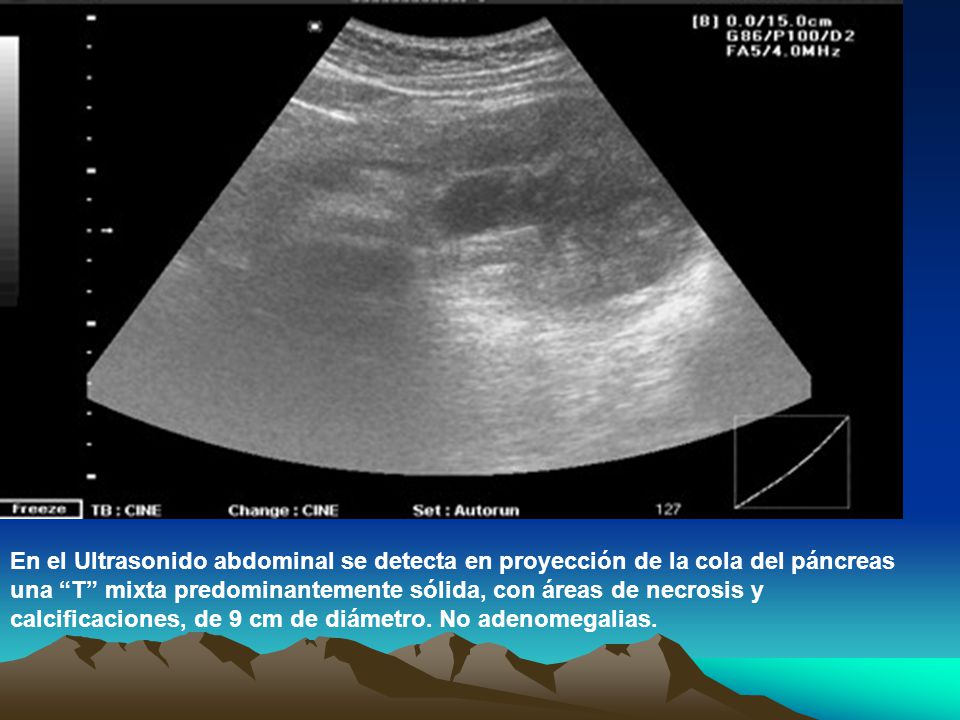 En el Ultrasonido abdominal se detecta en proyección de la cola del páncreas una T mixta predominantemente sólida, con áreas de necrosis y calcificaciones, de 9 cm de diámetro.