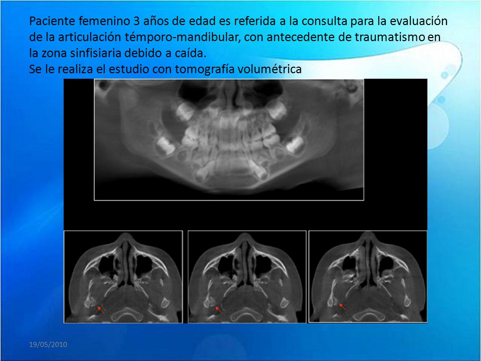 Paciente femenino 3 años de edad es referida a la consulta para la evaluación de la articulación témporo-mandibular, con antecedente de traumatismo en la zona sinfisiaria debido a caída. Se le realiza el estudio con tomografía volumétrica