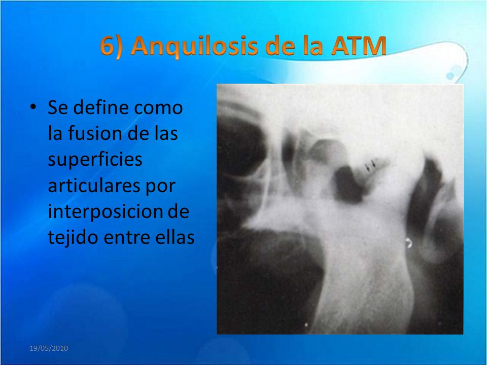 6) Anquilosis de la ATM Se define como la fusion de las superficies articulares por interposicion de tejido entre ellas.