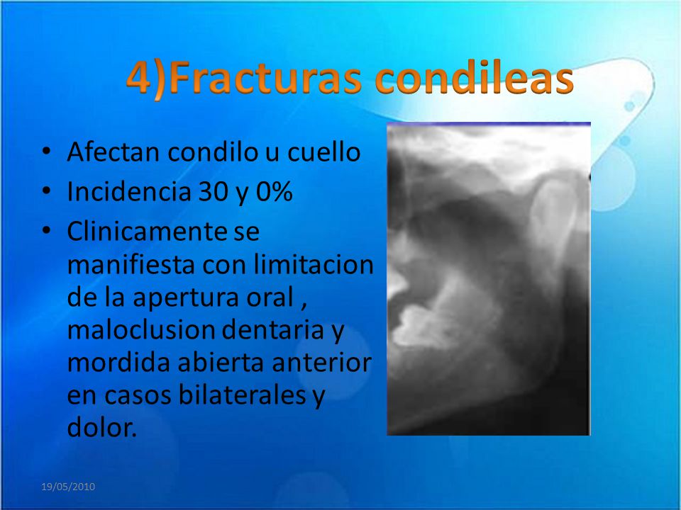4)Fracturas condileas Afectan condilo u cuello Incidencia 30 y 0%