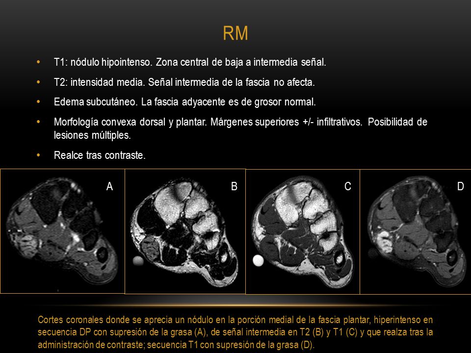 RM T1: nódulo hipointenso. Zona central de baja a intermedia señal. T2: intensidad media. Señal intermedia de la fascia no afecta.