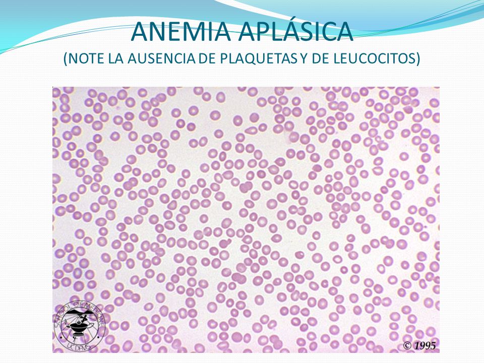 ANEMIA APLÁSICA (NOTE LA AUSENCIA DE PLAQUETAS Y DE LEUCOCITOS)