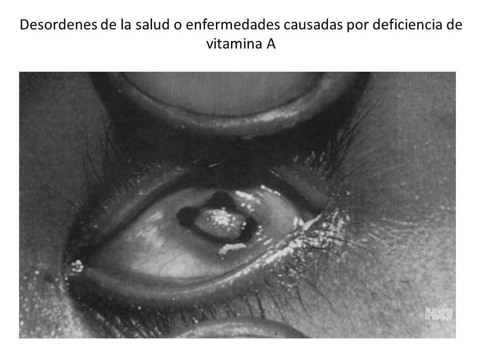 Desordenes de la salud o enfermedades causadas por deficiencia de vitamina A