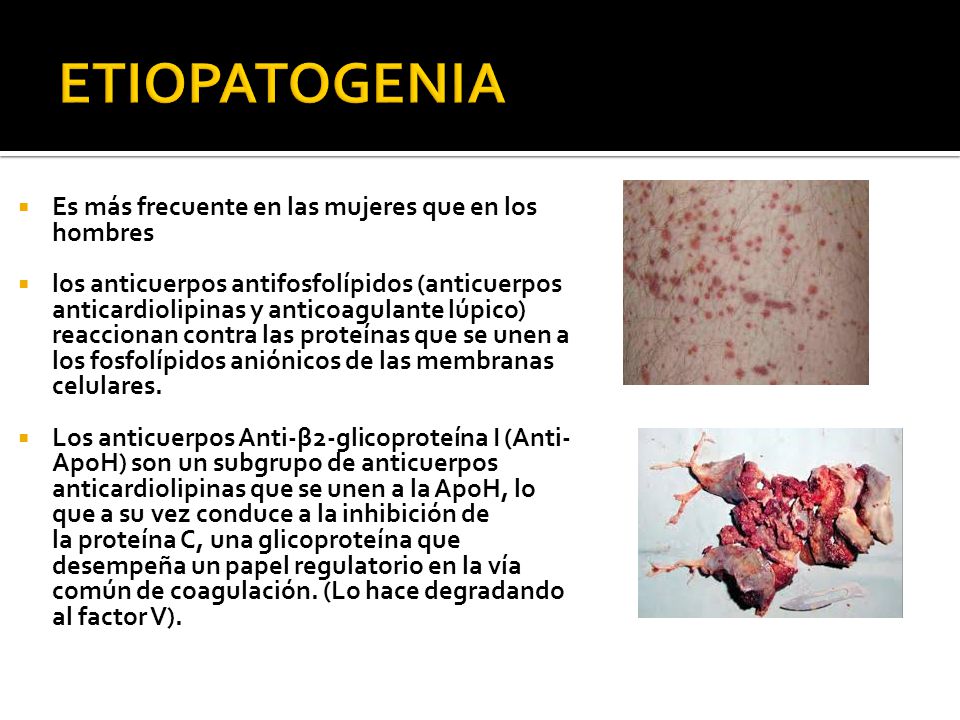 ETIOPATOGENIA Es más frecuente en las mujeres que en los hombres