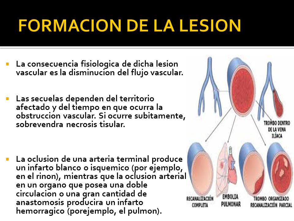 FORMACION DE LA LESION La consecuencia fisiologica de dicha lesion vascular es la disminucion del flujo vascular.